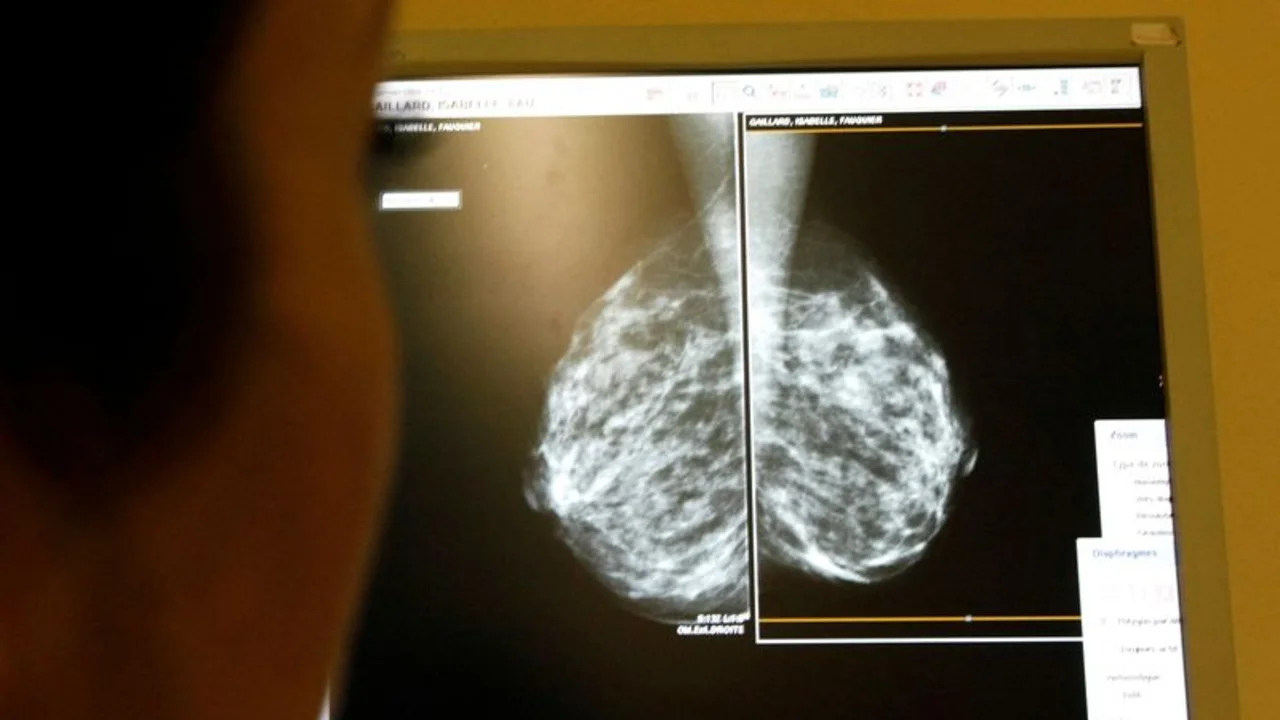 Descubren nuevos genes del cáncer de mama en mujeres de ascendencia africana, podrían mejorar evaluación de riesgo