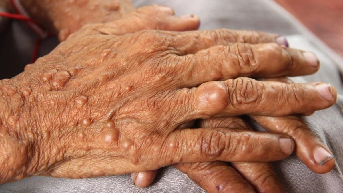 neurofibromatosis.