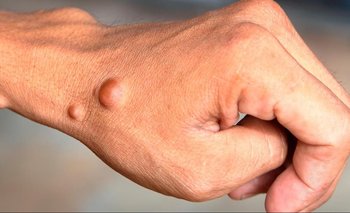 Qué es la neurofibromatosis, la enfermedad poco frecuente que exige diagnóstico | Salud