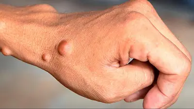 neurofibromatosis. neurofibromatosis.