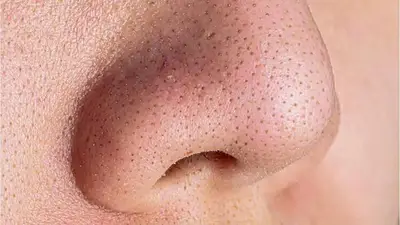 belleza, tratamiento estetico, nariz, puntos negros, belleza, tratamiento estetico, nariz, puntos negros,