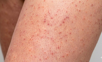 Chau piel de fresa: exfoliante casero con 4 ingredientes | Moda