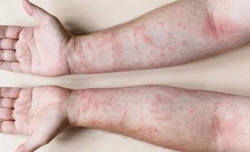 Fatiga extrema, dolor y síntomas silenciosos: las señales del lupus que muchos ignoran | Salud