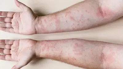 Fatiga extrema, dolor y síntomas silenciosos: las señales del lupus que muchos ignoran Fatiga extrema, dolor y síntomas silenciosos: las señales del lupus que muchos ignoran
