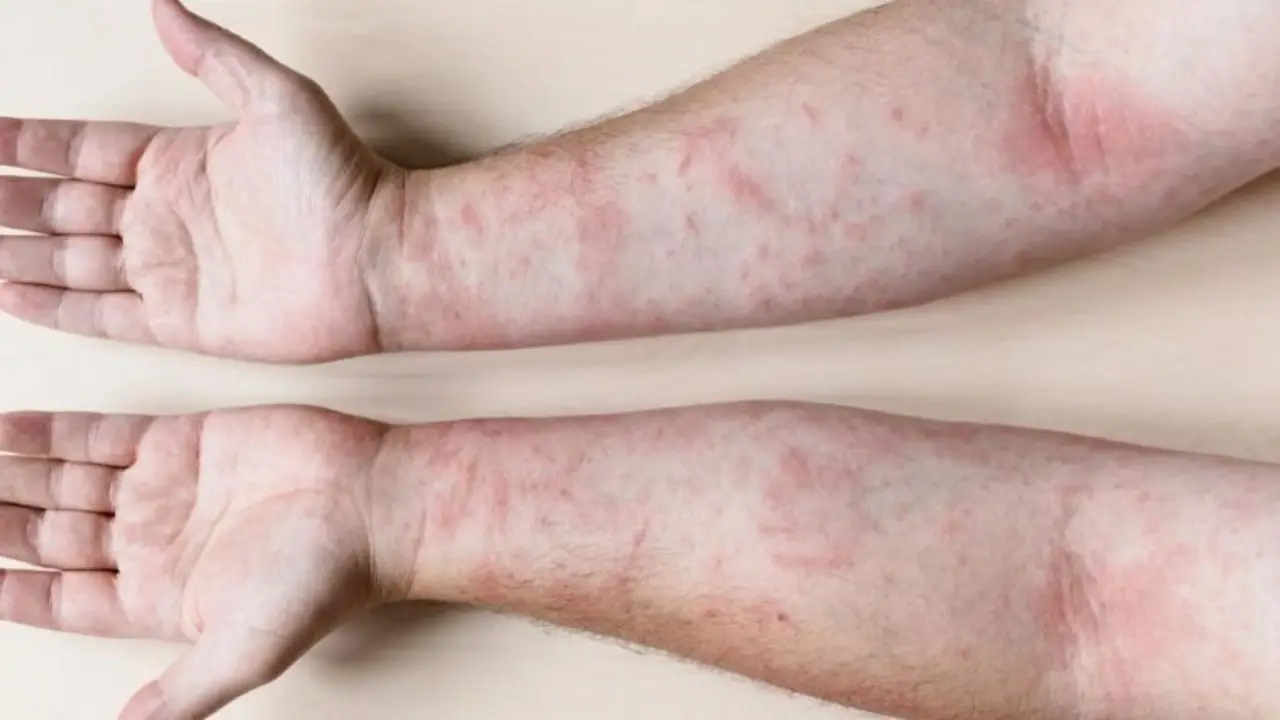 Fatiga extrema, dolor y síntomas silenciosos: las señales del lupus que muchos ignoran