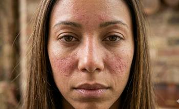 Chau rosácea: la mascarilla casera con un solo ingrediente | Belleza