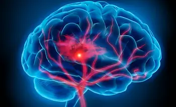 Crearon un programa nacional para el manejo del accidente cerebrovascular | Salud pública