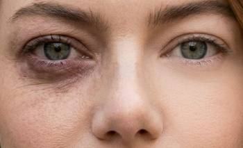 No más ojeras: la mascarilla casera más simple para disminuirlas | Belleza