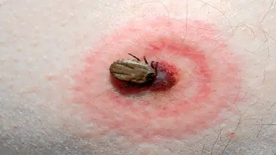 Enfermedad de Lyme, salud, enfermedades Enfermedad de Lyme, salud, enfermedades