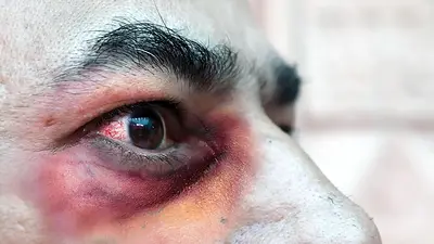 Hongo negro asociado a COVID-19: primer muerto en Argentina Hongo negro asociado a COVID-19: primer muerto en Argentina