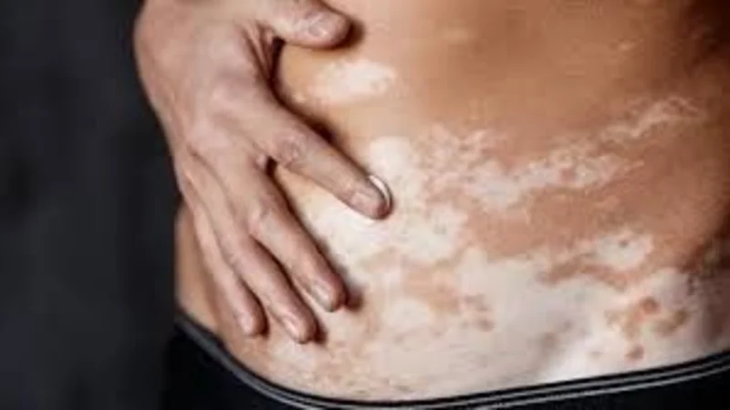 Enfermedades, salud, vitiligo