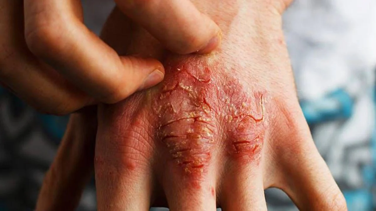Dermatitis atópica: afecta al 25% de niños y niñas y llaman a difundir el tratamiento