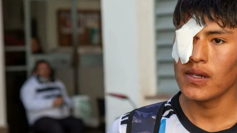 Jujuy: un adolescente perdió un ojo por una bala de goma