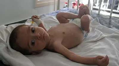 Los médicos aceleran la detección de la desnutrición infantil en Gaza Los médicos aceleran la detección de la desnutrición infantil en Gaza