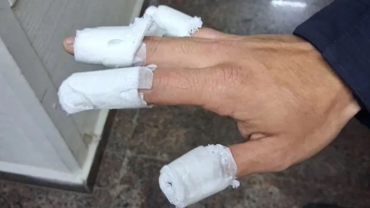 El policía atacado sufrió una quemadura de primer grado en la mano derecha.