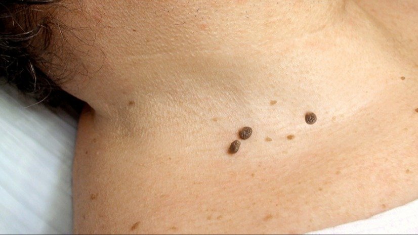 verrugas, consejos de belleza, belleza,