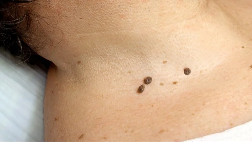 verrugas, consejos de belleza, belleza,