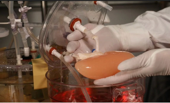 Hito: por primera vez, tratan a un paciente con un hígado fabricado en el laboratorio | Ciencia 