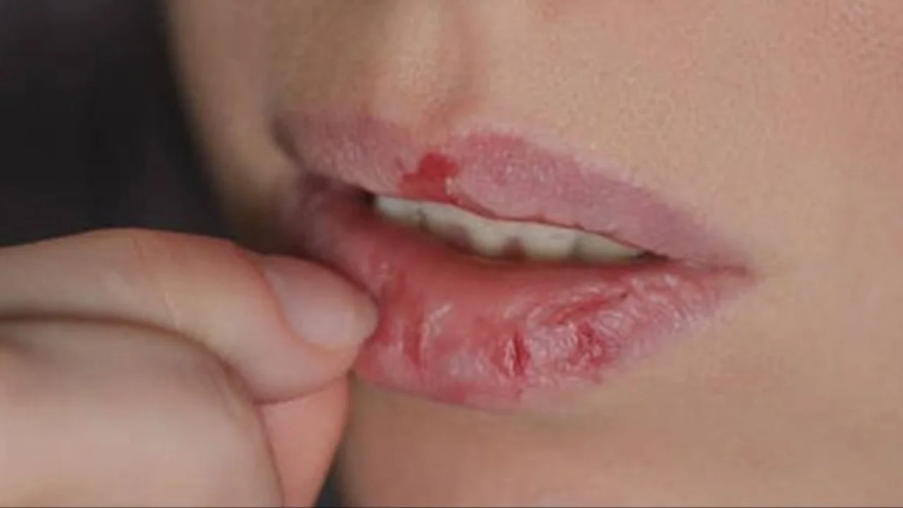 labios, frío, ola polar