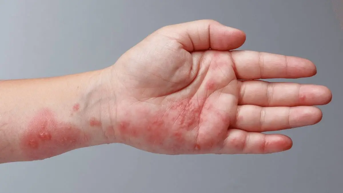 Dermatitis atópica.