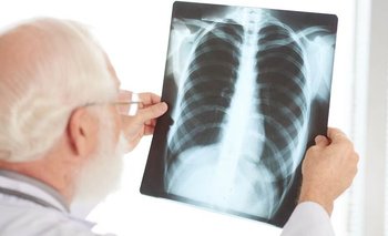 Alerta en Argentina: aumentaron un 38% los casos de tuberculosis | Salud
