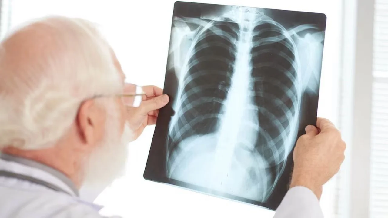 Alerta en Argentina: aumentaron un 38% los casos de tuberculosis
