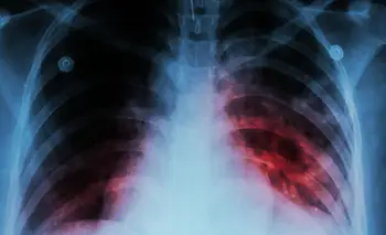 Alerta por récord de tuberculosis en la Argentina y preocupa el ascenso por su letalidad | Tuberculosis