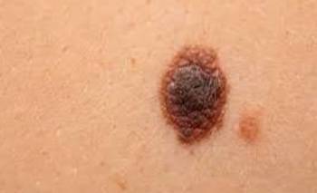 El Clínicas advierte sobre un error común que puede aumentar el riesgo de cáncer | Salud