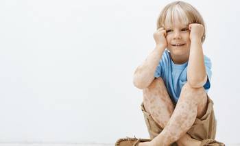 Lo que casi nadie sabe sobre el vitiligo: los mitos que los especialistas buscan derribar | Salud