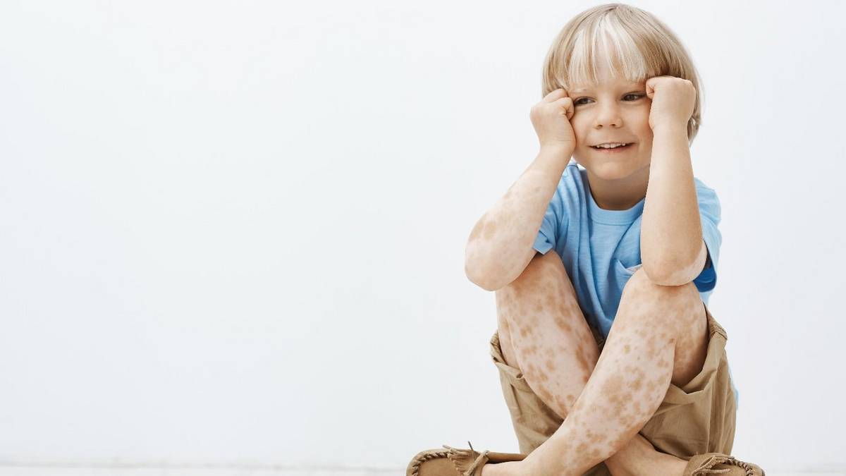 Lo que casi nadie sabe sobre el vitiligo: los mitos que los especialistas buscan derribar