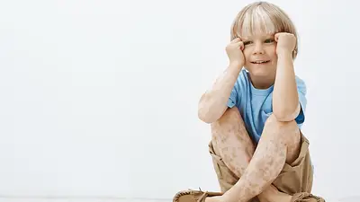 Qué es el vitiligo y cuáles son los prejuicios que enfrentan las personas que lo sufren. Día mundial del Vitiligo, por qué se conmemora. Qué es el vitiligo y cuáles son los prejuicios que enfrentan las personas que lo sufren. Día mundial del Vitiligo, por qué se conmemora.