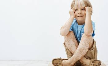Día Mundial del Vitiligo: qué es y cuáles son las causas | Salud