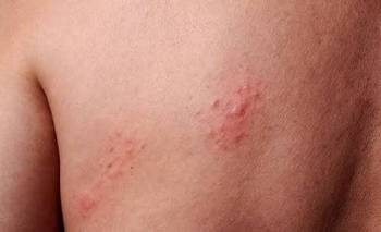 Qué es el herpes zóster, la enfermedad que sufrió Scaloni  | Salud