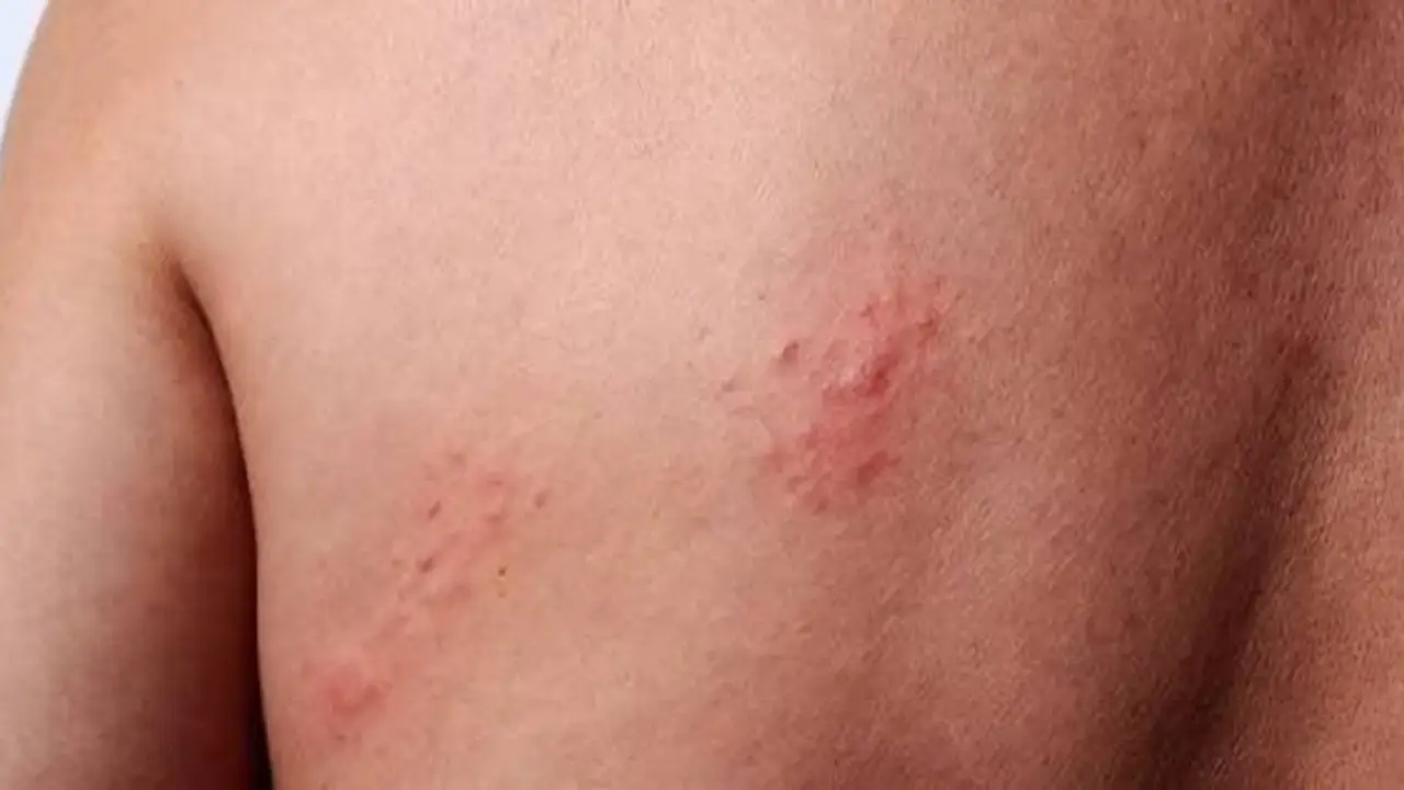 Qué es el herpes zóster, la dolorosa enfermedad que sufrió Lionel Scaloni tras el Mundial