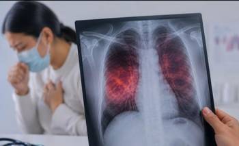 Tuberculosis en Santa Fe: más de mil casos en 2025 y aumento considerable este año | Salud