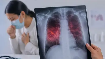 Tuberculosis: Santa Fe registró más de mil casos en 2025 y se ubica entre las provincias con mayor propagación Tuberculosis: Santa Fe registró más de mil casos en 2025 y se ubica entre las provincias con mayor propagación