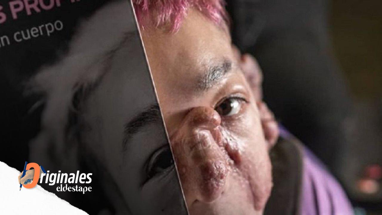 Matías Fernández y su rara enfermedad: "El libro me ayudó a conocer mi cuerpo y la mirada de los demás"