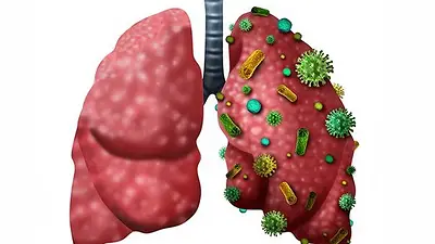 ¿Cuál es la diferencia entre neumonía y pulmonía? ¿Cuál es la diferencia entre neumonía y pulmonía?