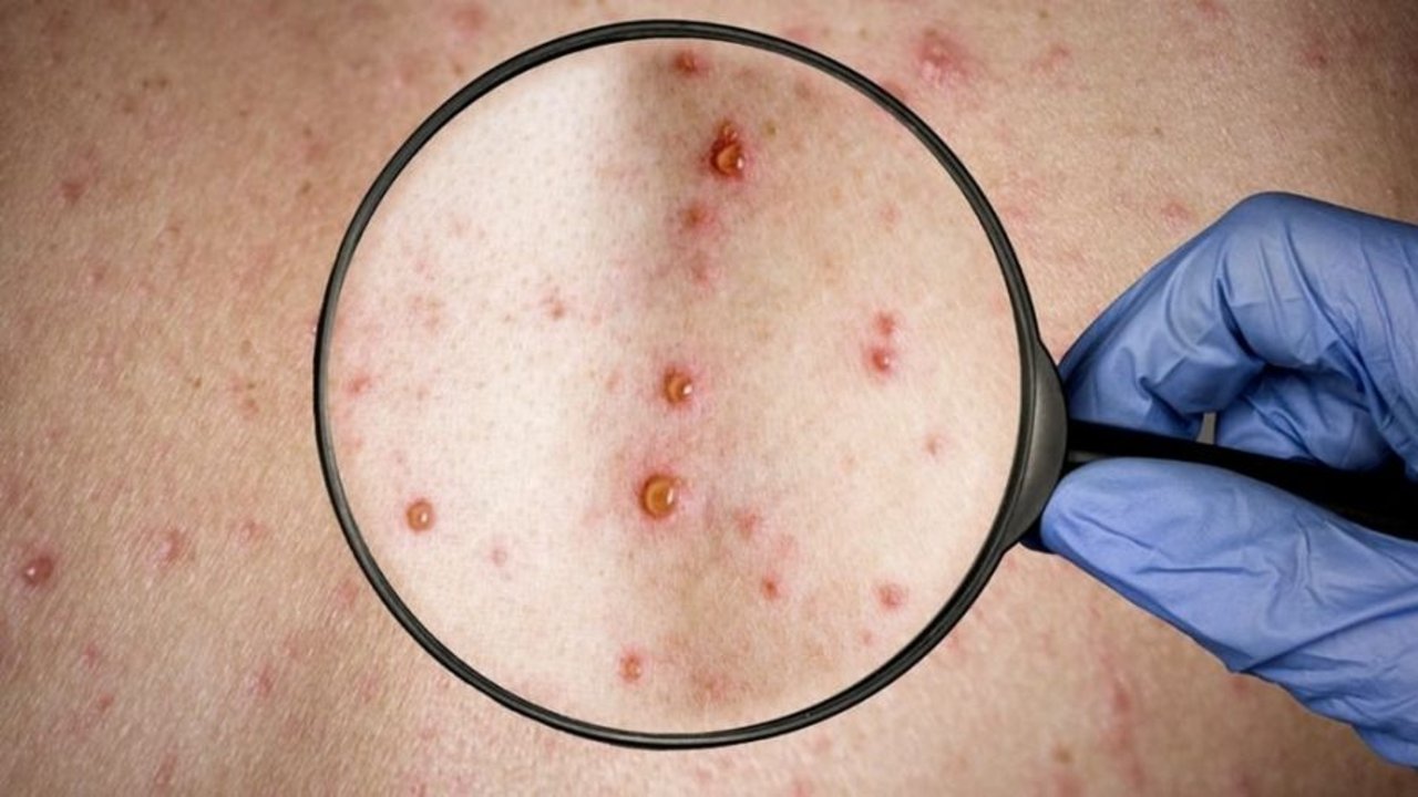 La Unión Europea aprobó el uso de una vacuna contra la viruela del mono