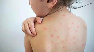 Alerta brote sarampión en el AMBA: detectan tres nuevos casos y 300 sospechosos Alerta brote sarampión en el AMBA: detectan tres nuevos casos y 300 sospechosos