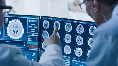 Qué es un edema cerebral, el cuadro por el que murió la joven que consumió éxtasis en Córdoba Qué es un edema cerebral, el cuadro por el que murió la joven que consumió éxtasis en Córdoba
