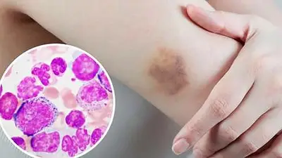 Qué es la citometría de flujo, la tecnología que significa un gran aporte para la detección de leucemia. Qué es la citometría de flujo, la tecnología que significa un gran aporte para la detección de leucemia.