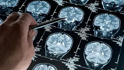 Cuál fue el hallazgo que hicieron los científicos argentinos sobre el Alzheimer. Cuál fue el hallazgo que hicieron los científicos argentinos sobre el Alzheimer.