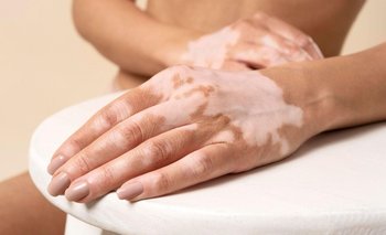 Vitíligo: qué es y las 5 claves para entender esta condición de la piel | Salud