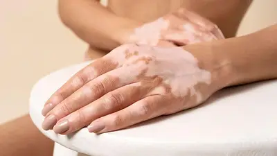 Vitíligo: qué es y las 5 claves para entender esta condición de la piel Vitíligo: qué es y las 5 claves para entender esta condición de la piel