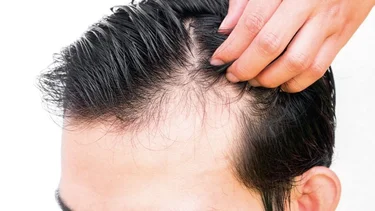 Es más fácil de lo que muchos creen: el particular componente que podría curar la calvicie masculina
