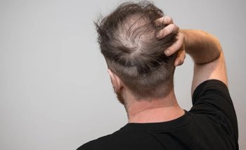 Chau calvicie: la ciencia logra hacer crecer cabello en folículos | Ciencia 