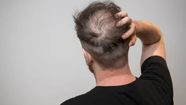 Chau calvicie: la ciencia logra hacer crecer cabello en folículos