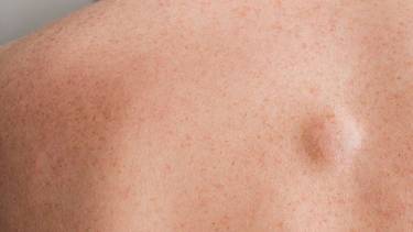 Qué es el sarcoma: síntomas, tratamientos y todo lo que hay que saber