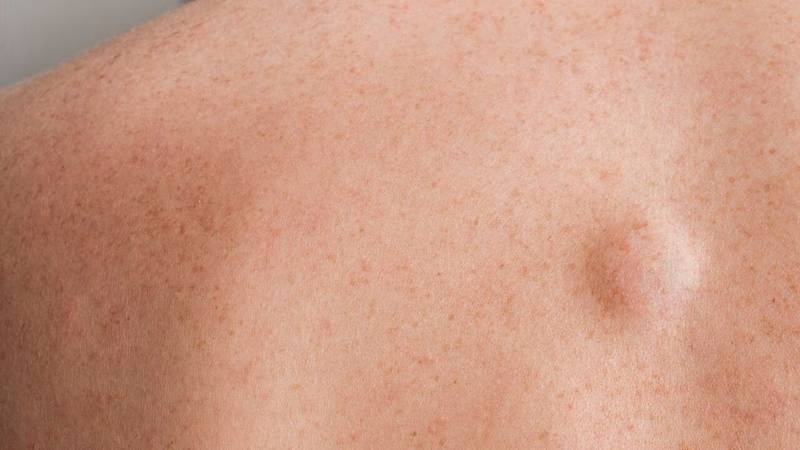 Sarcoma.